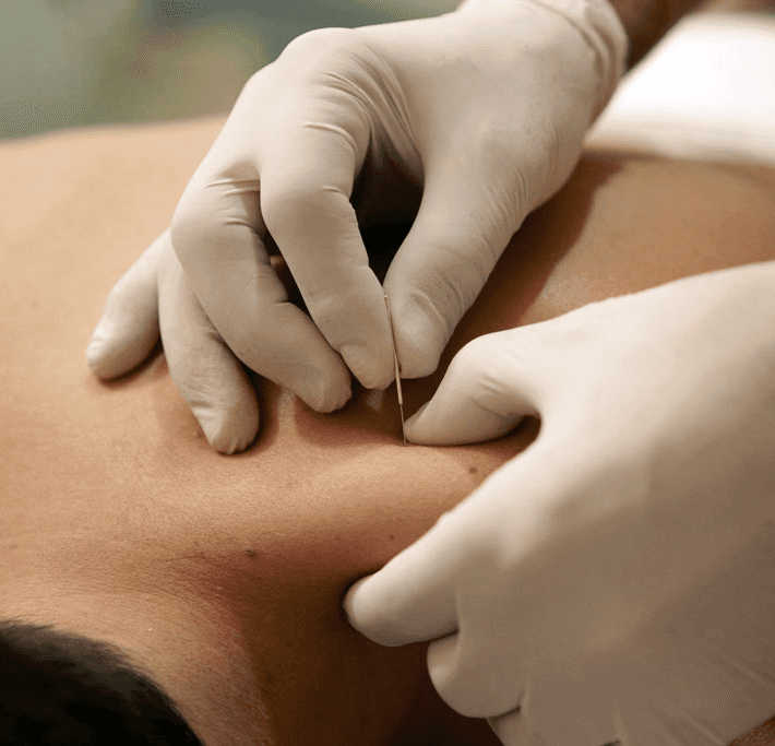 Curso de Dry Needling